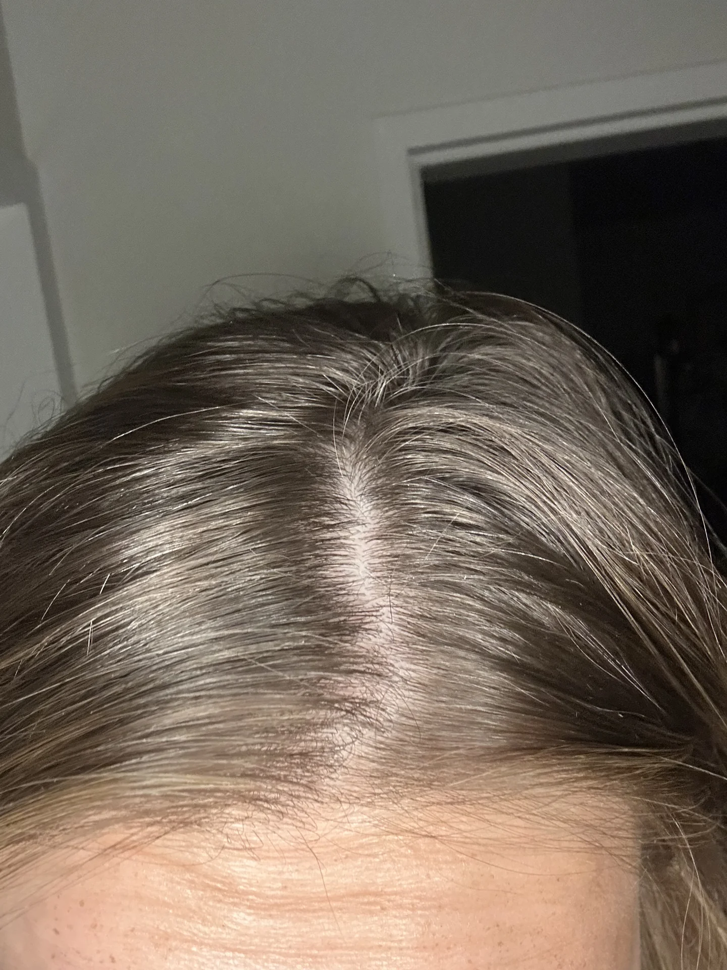 Nicole’s hair part and scalp before serum application